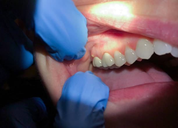 Best Emergency Treatment for Dental Infections or Abscesses in Trumann, AR